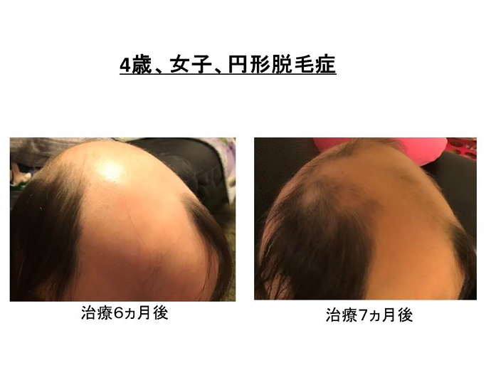 円形脱毛症　病院""